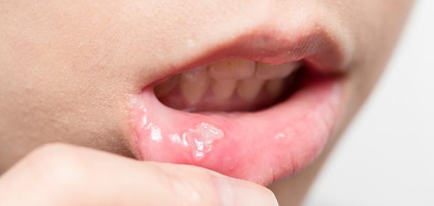 دليلك الشامل للحبوب البيضاء داخل الفم